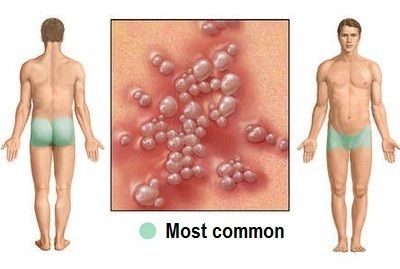 Symptoms of Male Genital Herpes