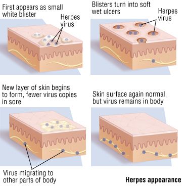 Herpes appearence