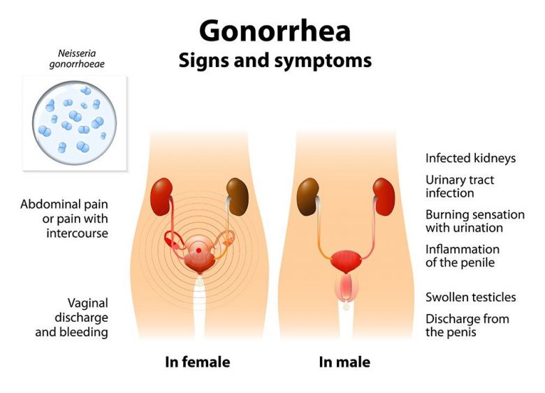 Gonorrhea Signs and Symptoms - In female , In male