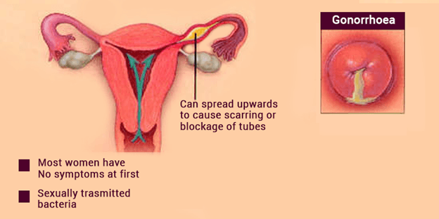 Gonorrhea symptoms in women