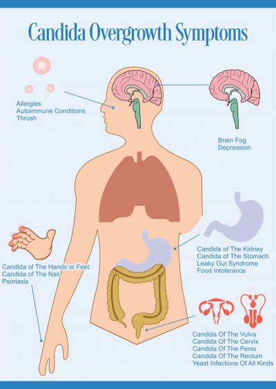 All About Candidiasis Thrush And Yeast Infection