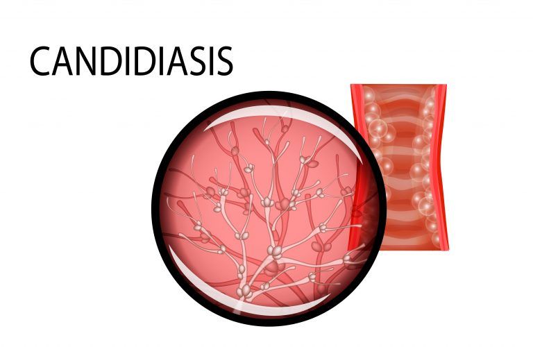Candidiasis