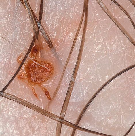 Pediculosis pubis