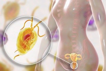 Female trichomoniasis – Trichomonas vaginalis parasite