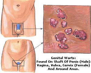 Genital Warts Male and Female