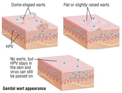 Genital wart appearance