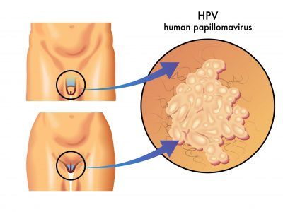 HPV (human papillomavirus) in men and women