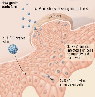 How genital warts form