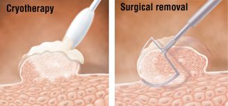 Warts treatment – Cryotherapy and Surgical removal