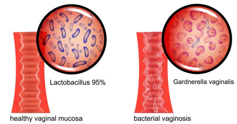 Healthy vaginal mucosa (Lactobacillus) vs bacterial vaginosis BV (Gardnerella vaginalis)