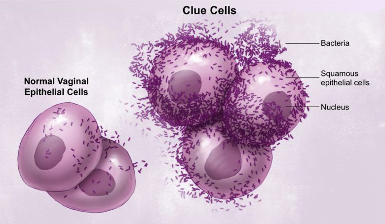 Normal Vaginal Epithelial Cells vs Clue Cells