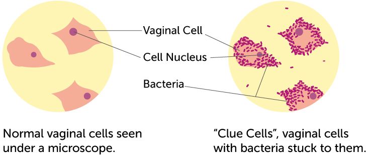 Normal vaginal cells seen under a microscope vs Clue cells (vaginal cells with bacteria stuck to them)