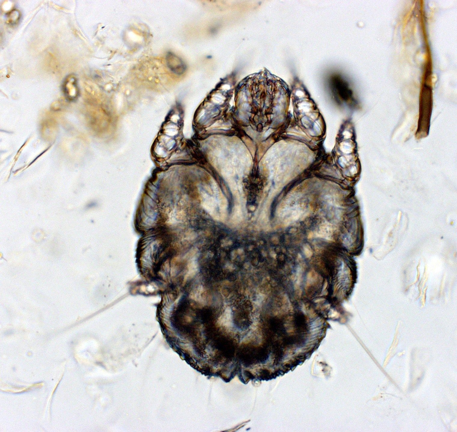 Scabies (Sarcoptes scabiei)