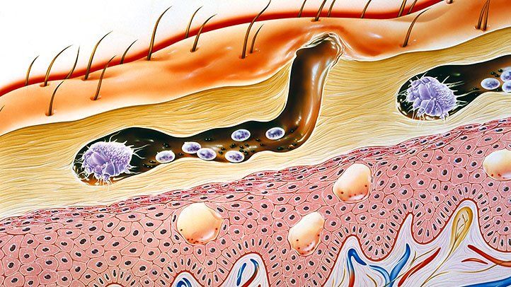 Scabies mites Scabies mites