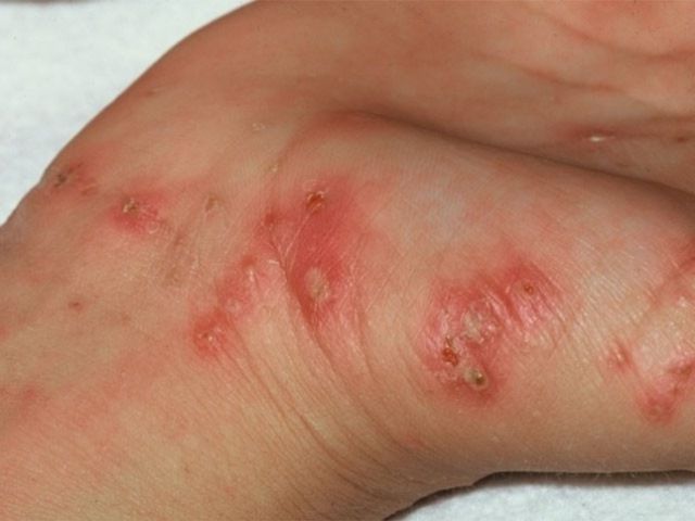 Scabies rash on hand