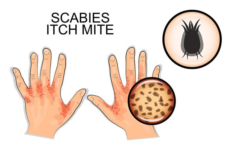 scabies itch mite
