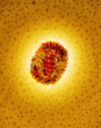 Molluscum Contagiosum Virus (MCV). Coloured transmission electron micrograph of MCV.