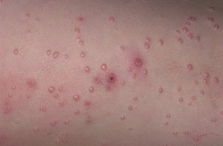 Molluscum Contagiosum picture