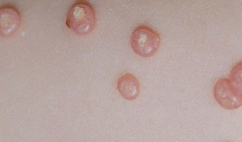 Molluscum bumps