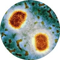 Molluscum Contagiosum (MC), Water Warts What is Molluscum Contagiosum (MC)? Water Warts. MC causes, signs, symptoms and treatment.