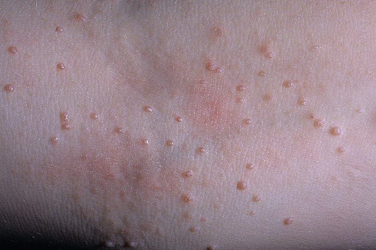 Small pearly-white or slightly pink lumps (mollusca) on the skin