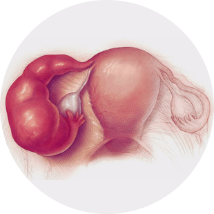 Pelvic Inflammatory Disease (PID) Pelvic Inflammatory Disease (PID)