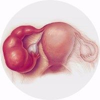 Pelvic Inflammatory Disease (PID) Pelvic Inflammatory Disease (PID). What is it? Causes, Signs, Symptoms, Diagnosis, Treatment, and more.