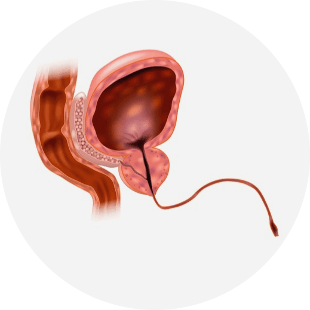 Non-Gonococcal Urethritis (NGU) Non-Gonococcal Urethritis (NGU)