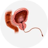 Non-Gonococcal Urethritis (NGU) What is non-gonococcal urethritis (NGU) or non-specific urethritis (NSU)? How is it transmitted? NGU/NSU causes, symptoms, treatment and prevention.